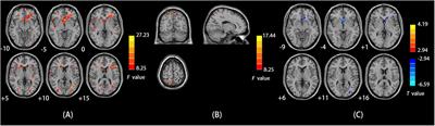 Sex Differences in Spontaneous Brain Activity in Adolescents With Conduct Disorder